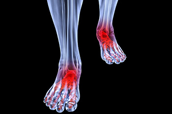 Arthritic foot and ankle care treatment in the Dallas County, TX: Dallas (Garland, Richardson, Addison, Carrollton, Farmers Branch, University Park, Highland Park, Irving, Cockrell Hill, Duncanville, Hutchins, Lancaster, DeSoto, Cedar Hill, Grand Prairie, Glenn Heights) and Ellis County, TX: Red Oak, Oak Leaf, Ovilla areas