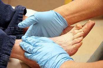 Diabetic foot care in the Dallas County, TX: Dallas (Garland, Richardson, Addison, Carrollton, Farmers Branch, University Park, Highland Park, Irving, Cockrell Hill, Duncanville, Hutchins, Lancaster, DeSoto, Cedar Hill, Grand Prairie, Glenn Heights) and Ellis County, TX: Red Oak, Oak Leaf, Ovilla areas