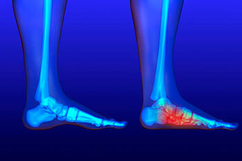 Flat Feet and Fallen Arches Treatment in the Dallas County, TX: Dallas (Garland, Richardson, Addison, Carrollton, Farmers Branch, University Park, Highland Park, Irving, Cockrell Hill, Duncanville, Hutchins, Lancaster, DeSoto, Cedar Hill, Grand Prairie, Glenn Heights) and Ellis County, TX: Red Oak, Oak Leaf, Ovilla areas