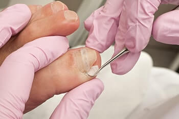 Ingrown toenail specialist in the Dallas County, TX: Dallas (Garland, Richardson, Addison, Carrollton, Farmers Branch, University Park, Highland Park, Irving, Cockrell Hill, Duncanville, Hutchins, Lancaster, DeSoto, Cedar Hill, Grand Prairie, Glenn Heights) and Ellis County, TX: Red Oak, Oak Leaf, Ovilla areas