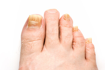 Fungal toenails treatment in the Dallas, TX 75230 and 75233 areas