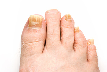 Toenail fungus treatment in the Dallas County, TX: Dallas (Garland, Richardson, Addison, Carrollton, Farmers Branch, University Park, Highland Park, Irving, Cockrell Hill, Duncanville, Hutchins, Lancaster, DeSoto, Cedar Hill, Grand Prairie, Glenn Heights) and Ellis County, TX: Red Oak, Oak Leaf, Ovilla areas