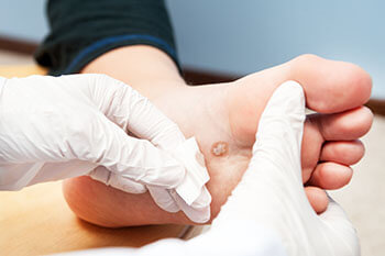 Plantar Warts Treatment in the Dallas County, TX: Dallas (Garland, Richardson, Addison, Carrollton, Farmers Branch, University Park, Highland Park, Irving, Cockrell Hill, Duncanville, Hutchins, Lancaster, DeSoto, Cedar Hill, Grand Prairie, Glenn Heights) and Ellis County, TX: Red Oak, Oak Leaf, Ovilla areas