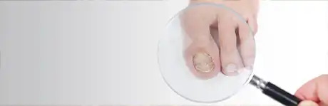 Fungal Tonails Treatment in the Dallas, TX 75230 and Dallas, TX 75233 areas