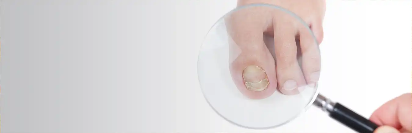 Fungal Tonails Treatment in the Dallas, TX 75230 and Dallas, TX 75233 areas