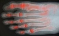 Various Forms of Arthritis